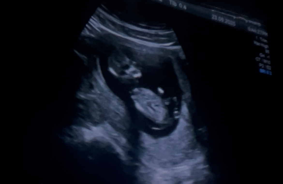 Baby scan